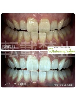 ホワイトニングサロン 広島店/【ホワイトニング施術例】