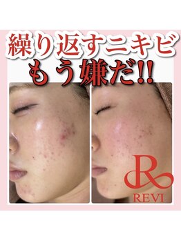 アルムダアクア 天王寺店(Aleumda AQUA)/ハーブピーリング/大阪/天王寺