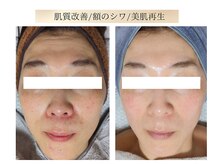 エボルブ 四条烏丸店(EVOLVE)/幹細胞ハーブピーリング