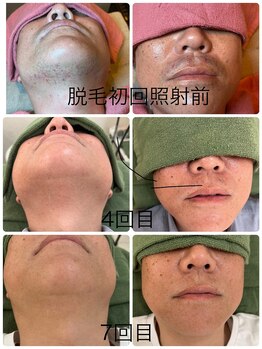 フォルトゥーナ ビューティー(Fortuna Beauty)の写真/カミソリ負けや肌荒れにさよなら！ヒゲから全身、VIOのメンズ脱毛で、清潔感あふれる快適肌へ☆