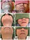 フォルトゥーナ ビューティー(Fortuna Beauty)の写真/カミソリ負けや肌荒れにさよなら！ヒゲから全身、VIOのメンズ脱毛で、清潔感あふれる快適肌へ☆