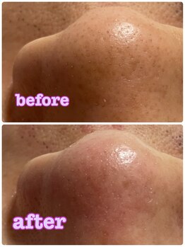 サンテ(Sante)/ハイドラフェイシャル