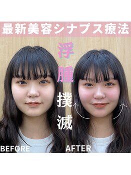 シナプスケアセンター 十三院(SYNAPSE CARE CENTER)/【シナプス療法】でむくみ解消