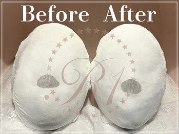 R-1ビューティーサロン 表参道/石膏パックBefore&After(15回)