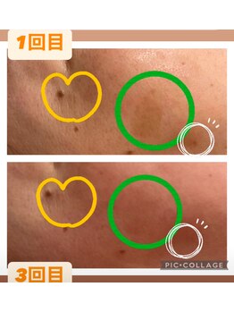 パルティノ 高崎店/シミケアで緩和