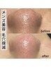 【５週以内の来店】毛穴洗浄（鎮静パック付き）¥5,980