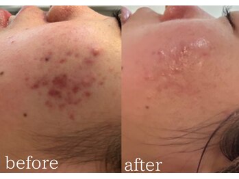ブライス(BLITHE)/before after
