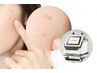 【全身脱毛専用オプション】美肌プラズマ￥5,500　脱毛と一緒にお顔のケア♪