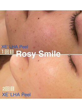 ロージースマイル(Rosy smile)/【韓国肌管理★ セラピール 】