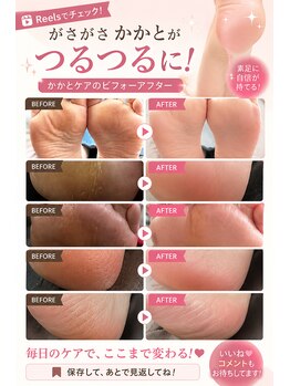 ナゴミエ(Nagomier)の写真/これから裸足の季節♪
カサカサ、タコ、魚の目からツルツルかかとへ。