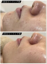 リノ レイ(Lino Ray)/当店人気NO.1水光ピーリング