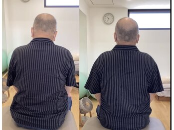 ランドル(rendre)/70代男性　１年前から肩こり