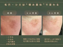 インヤン(yinyang)/50代前半｜シミ症例