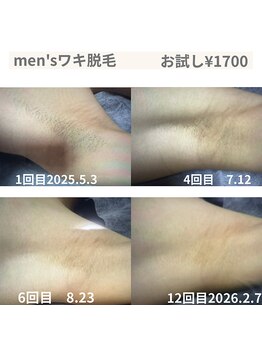 シェーングランツ(SchonGlanz)/ワキ脱毛ビフォーアフター