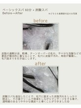 カピリナ(KaPilina)/頭皮のBefore→After