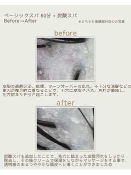 カピリナ(KaPilina)/頭皮のBefore→After