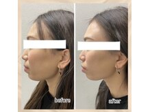 エンチャント(ENCHANT)/ウルトラお顔超音波リフト