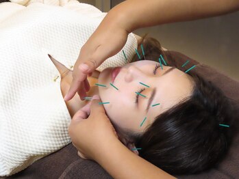 ウェルビープラーカ(Well-beプラーカ)/施術の流れ(５)お顔への鍼
