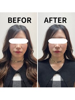 リノア 堀江(Linoa)/小顔矯正の施術前後写真