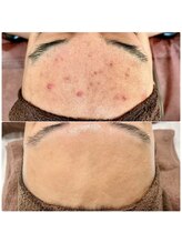 ラエッセ 恵比寿(LAESSE)/毛穴・美白専門店 LAESSE 恵比寿