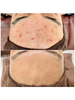 ラエッセ 恵比寿(LAESSE)/毛穴・美白専門店 LAESSE 恵比寿