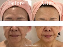 カレンジェビューティー(CarengeBeauty)/四日市エステ/小顔