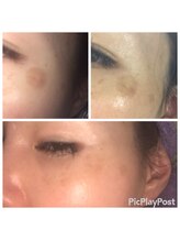 メナードフェイシャルサロン 伊那狐島/シミ改善ケアの秘訣♪