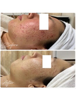 ビズビズ 梅田店(bisebise)/ニキビケア/ハイドラ毛穴洗浄