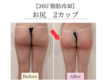 リボーン(REBORN)/お尻 2カップ