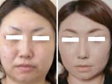 マリエンドリー/毛穴×小顔