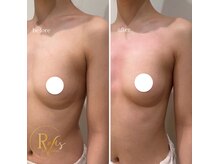 ラヴィス(ravis)/まぁるい綺麗なバスト！