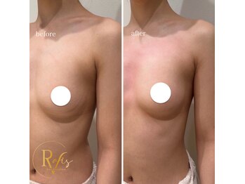 ラヴィス(ravis)/まぁるい綺麗なバスト!