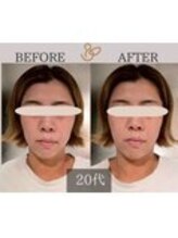 チョコバリ 錦糸町店(chocobari)/小顔×リフトアップ(美容鍼)20代