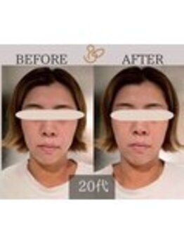 チョコバリ 錦糸町店(chocobari)/小顔×リフトアップ(美容鍼)20代