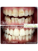 ホワイトニングサロン 広島店/【ホワイトニング施術例】