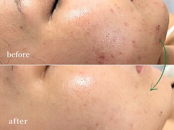 ソレイユ(Soleil)の写真/毛穴・黒ずみここまで変わる|クレンジングや洗顔では落ちない"詰まりの根本"にアプローチするピーリング