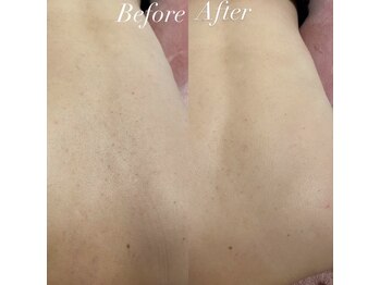 リンダ 西宮店(LINDA)/背面ハーブピーリング