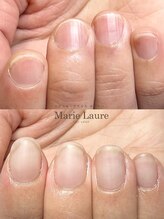 マリーロール 梅田店(Marie Laure)/自爪育成/深爪矯正/ネイルケア