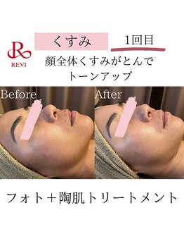 アイビー(IVY)/ハーブピーリング+光フォト