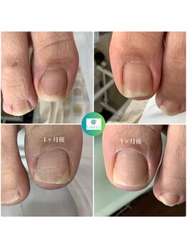 リゼラアンドコー たまプラーザ店/巻き爪補正