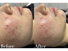 ビジュー(美柔 Bijou)/REVI剥離なしハーブピーリング