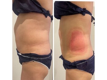 フラットベリー 恵比寿(Flat BELLY)/脂肪冷却4カップ