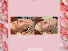 リリー ボヌール(Lily bonheur)/ソニックリフトトリートメント