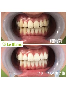 ルブラン 奈良店(Le Blanc)/ホワイトニングはじめの一歩!!