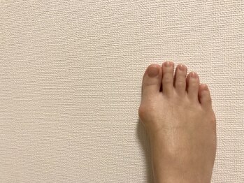 足圧宗家 良知整骨治療院/親指15度変形の痛み改善します