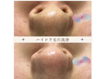 クリソレース(Chrysolace)の雰囲気（美容液で洗う毛穴洗浄。初回限定¥5980）