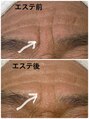 クラッシー 本八幡(CLASSY+)&nbsp;70代（フェイシャル）1回で眉間とおでこの皺がふっくら変化