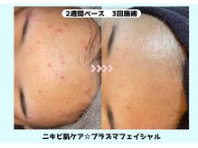 バベルトータルビューティー 北堀江店(Babel Total Beauty)/プラズマフェイシャル￥3000