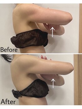 ボディヒーリングアンド小顔美容矯正 プララン/二の腕スッキリ♪