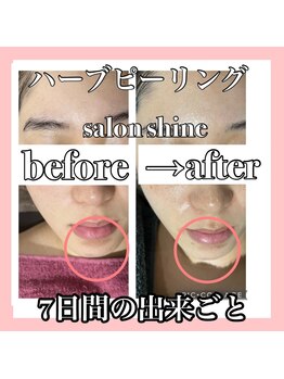 サロンシャイン(Salon Shine)/ハーブピーリングで驚きの7日間